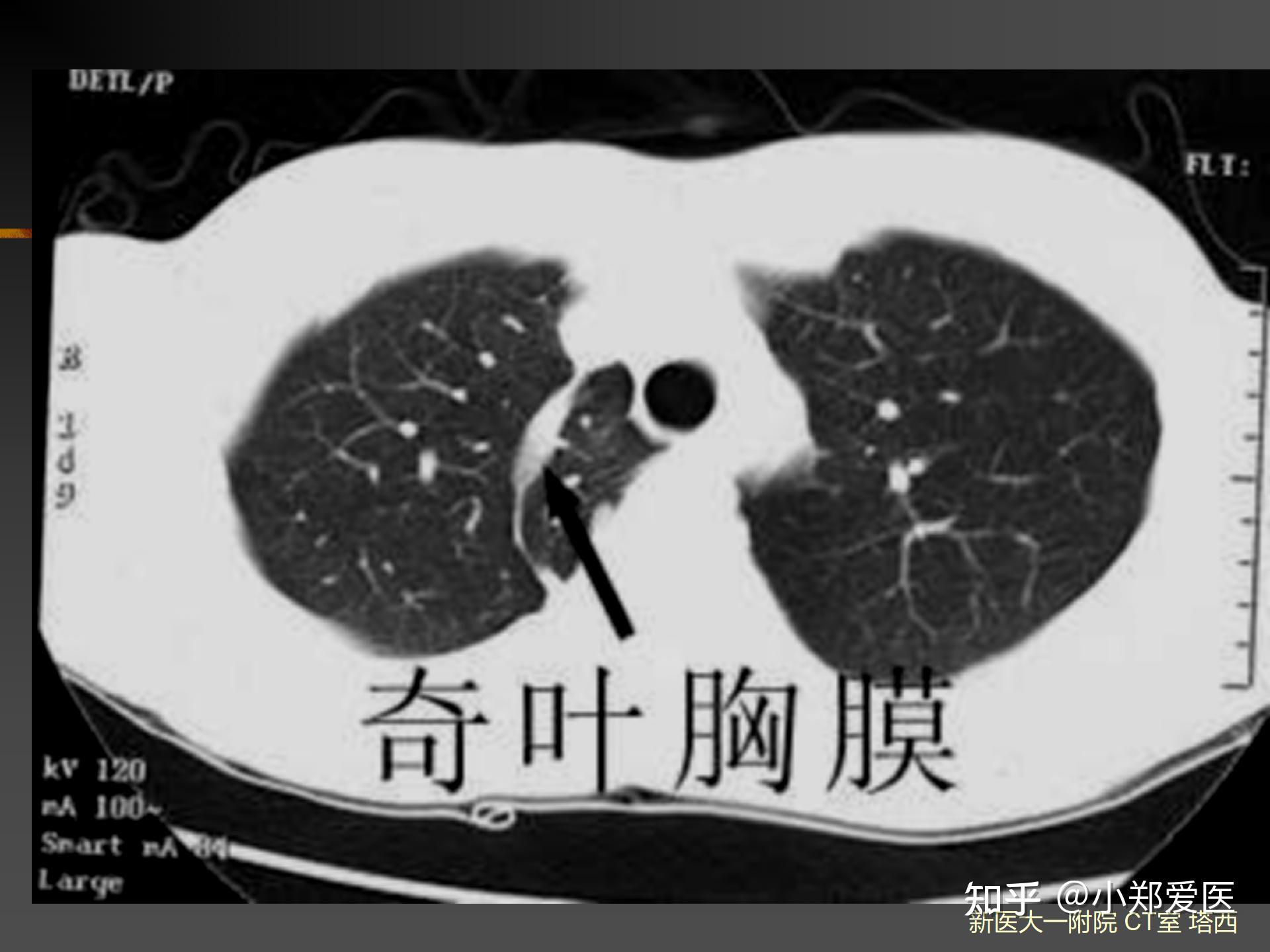 从0到1带你学会读CT片之呼吸系统影像学诊断(科普) - 知乎