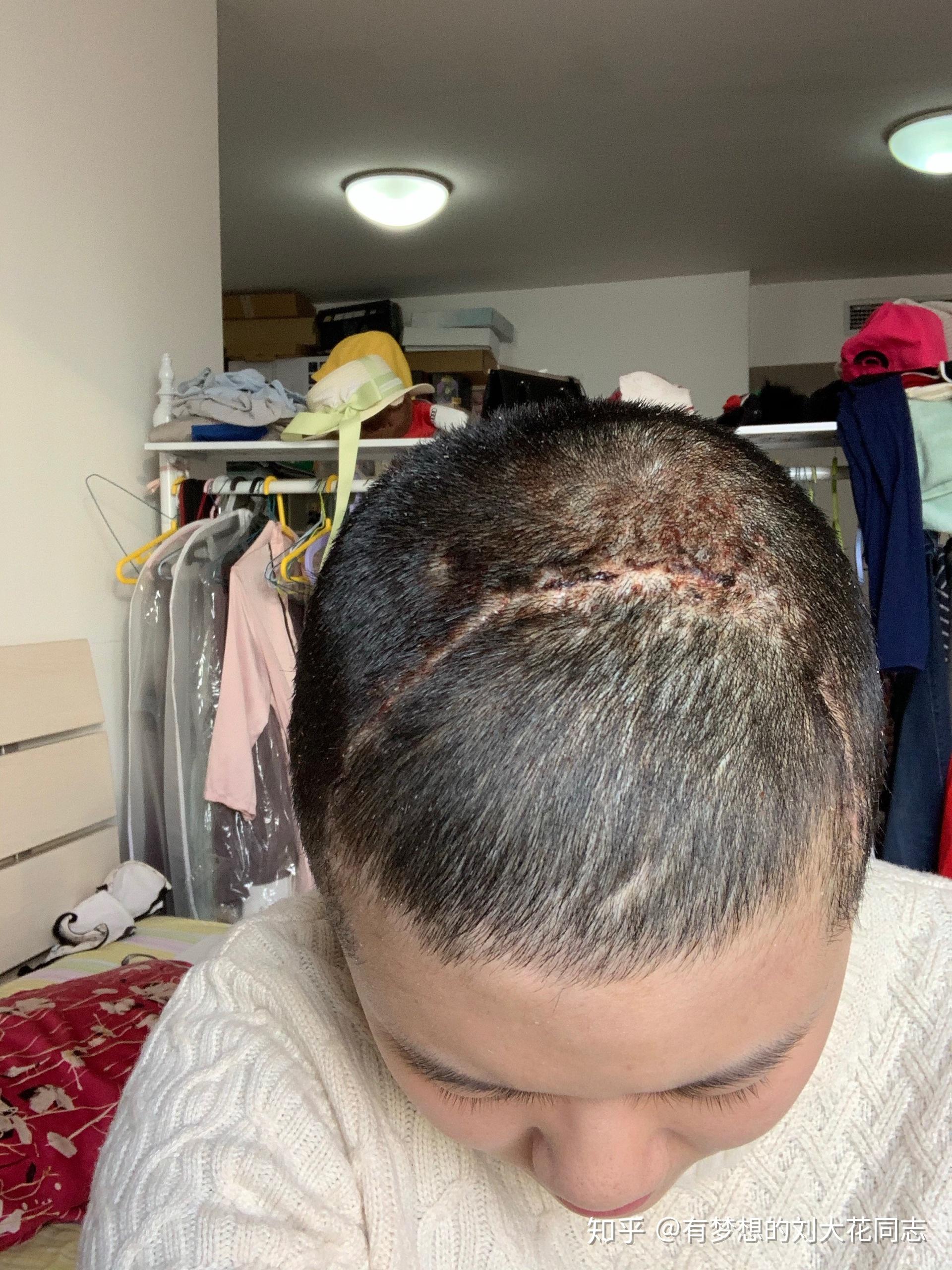 我头上长了一个颅骨骨瘤,专家说没有关系,可是我发现它在缓慢的长大