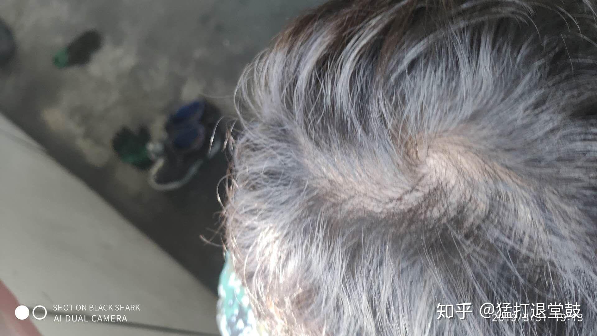 多少岁开始掉头发正常 v2-bd2a3ca9137756f2682c45012cf1f9fc_r.jpg