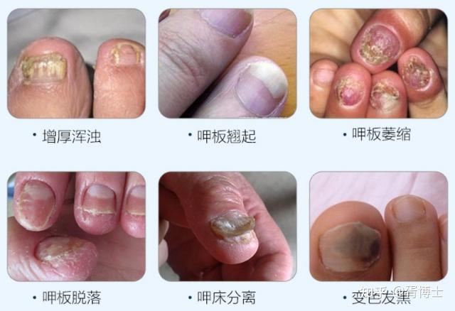 有谁知道这个指甲怎么办? - 知乎