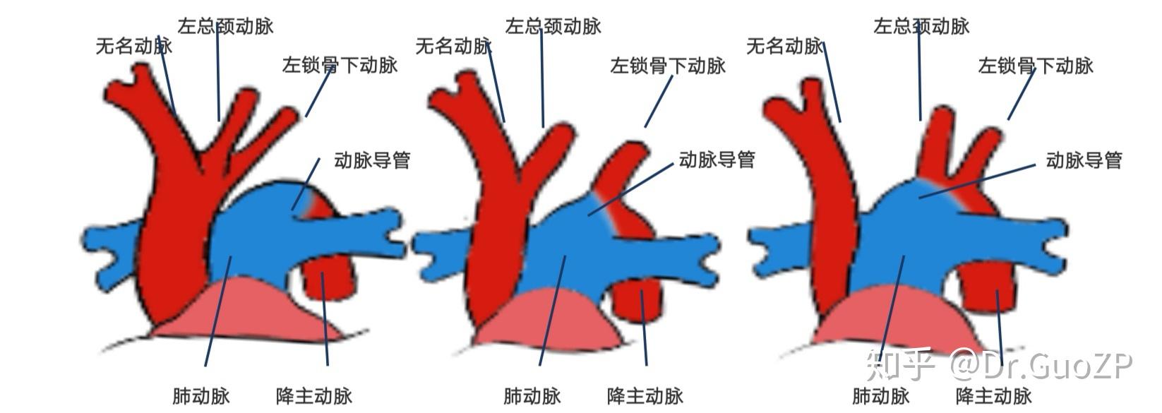 主动脉弓三型图解图片