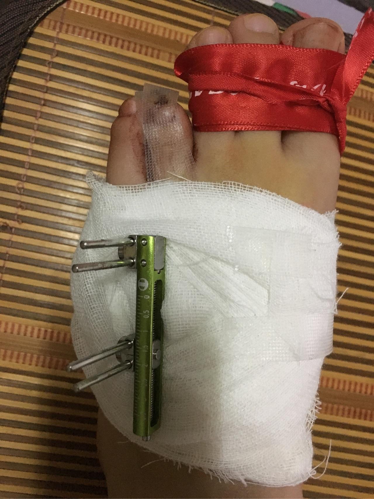 请问大概有多少人是先天性的第四脚趾短小症呢?