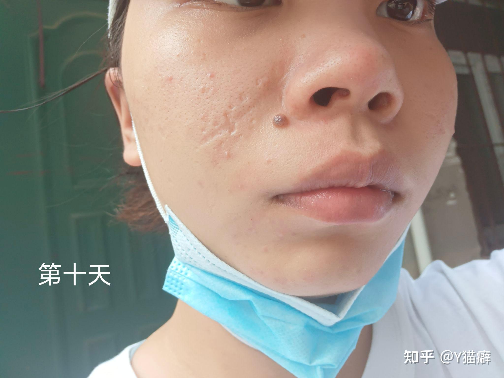 有没有人做过点阵激光祛疤做了几次效果怎么样