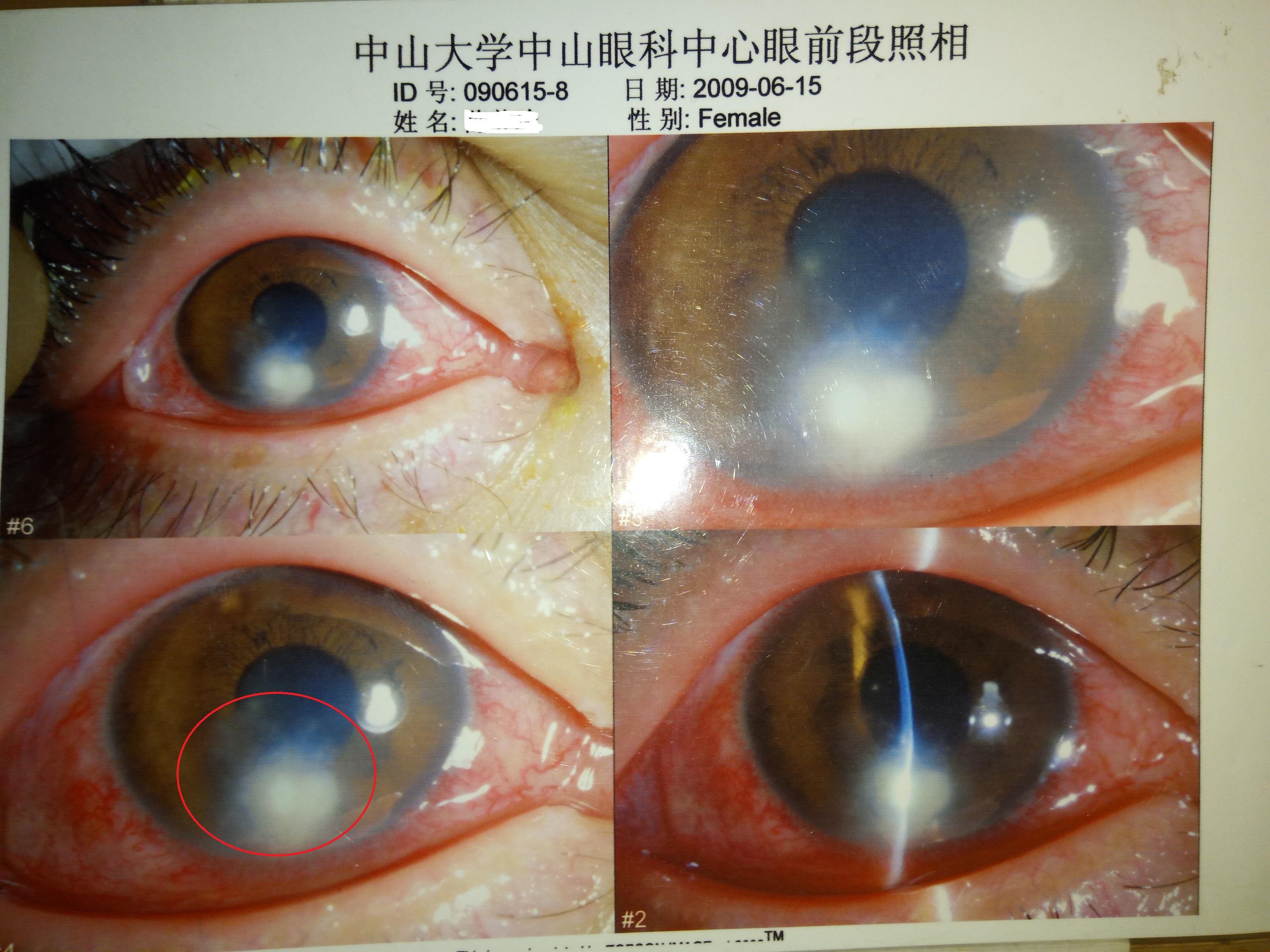 角膜炎照片图片