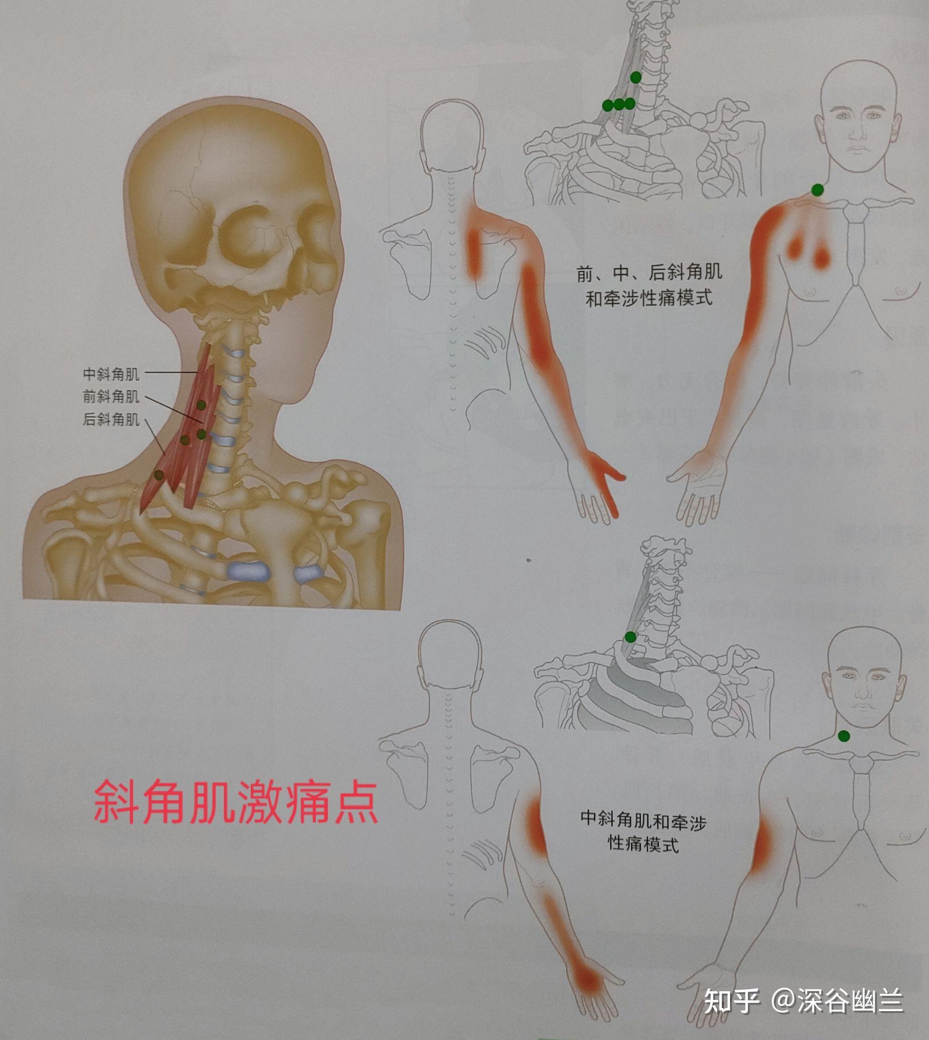 上背部疼痛与斜角肌,肩胛提肌,冈上肌,斜方肌,多裂肌,菱形肌,颈夹肌