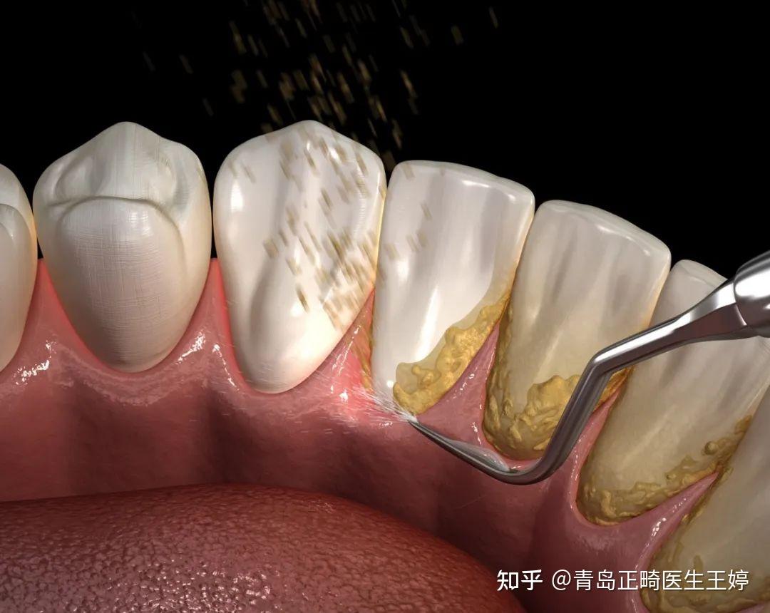 牙结石可以自己抠掉吗，教你4招，这样去除牙结石，安全有效_牙齿
