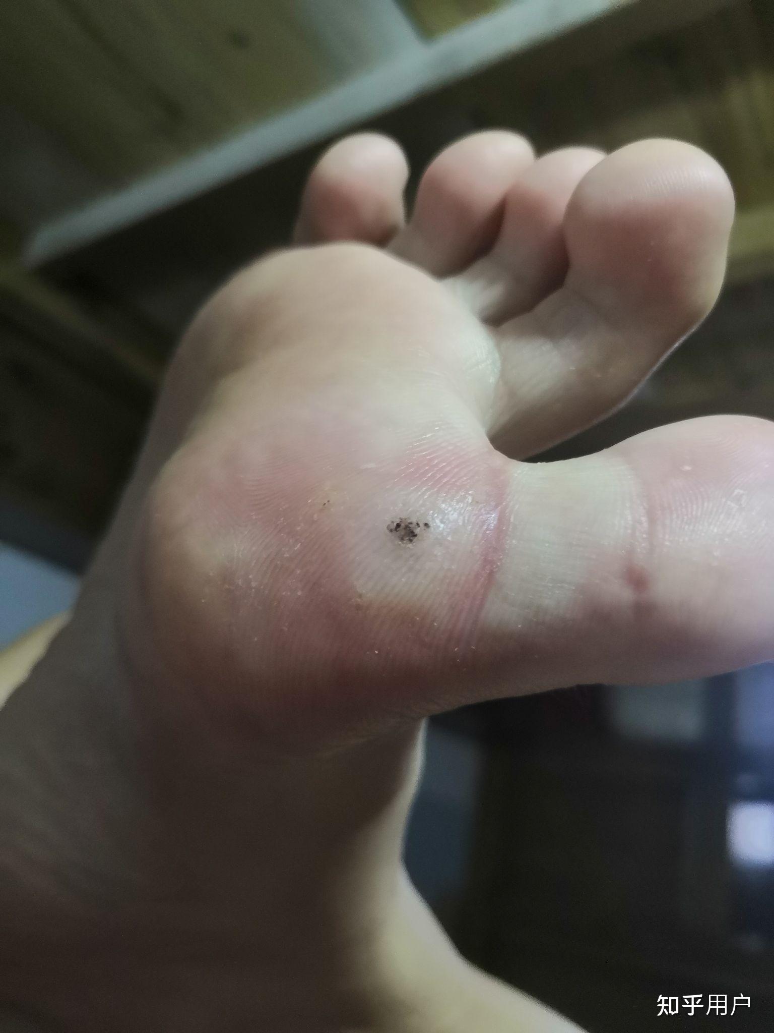 跖疣的自愈性大吗