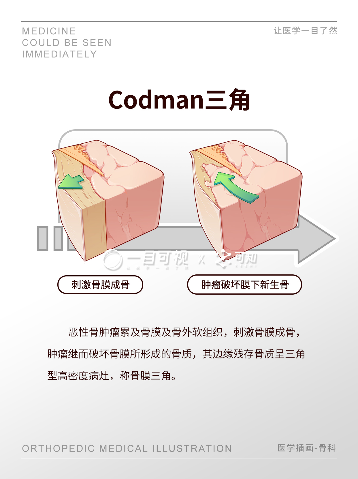 骨巨细胞瘤患者在生活中应该注意哪些细节?