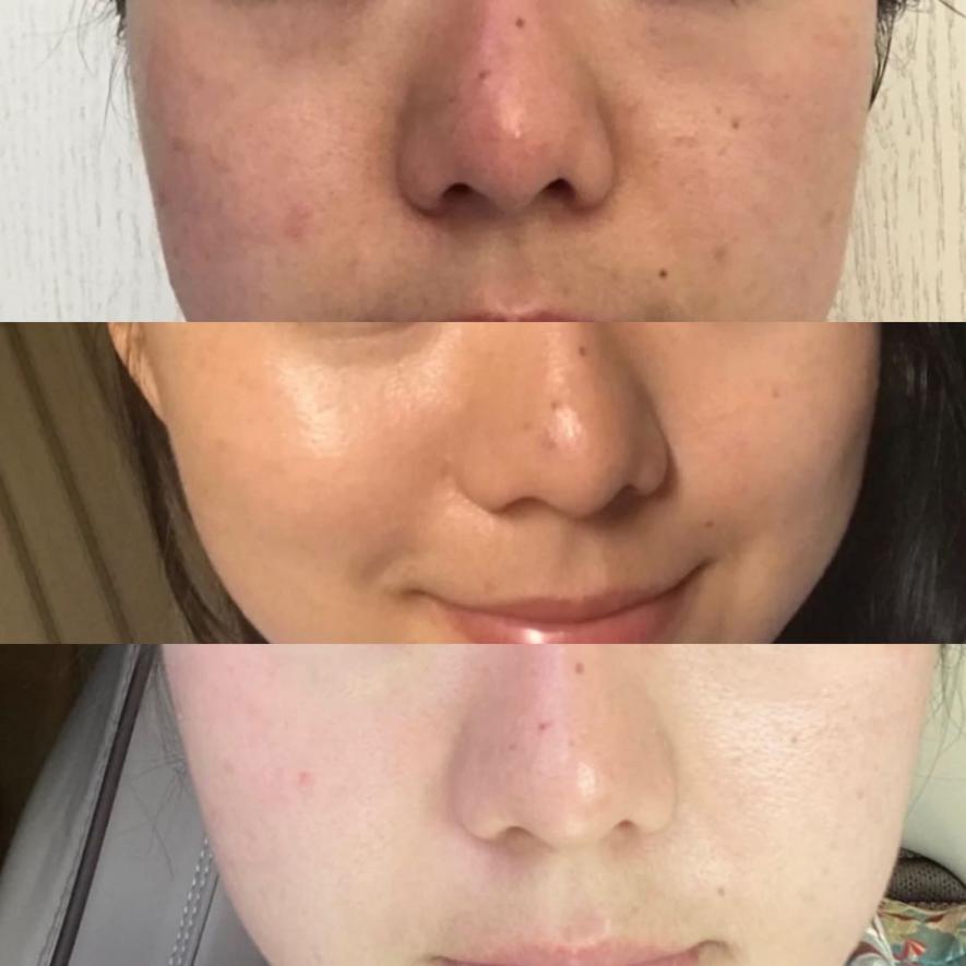 敏感肌油痘肌肤质怎样护肤如何改善脸颊泛红毛孔粗大和痘痘有哪些适合