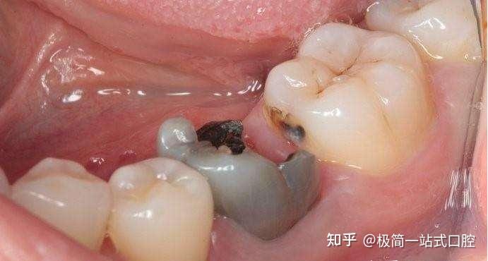牙齿残根到底要不要保留? - 知乎