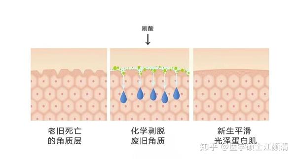 新手小白刷酸攻略|医学生教你超详细刷酸保姆级教程,最后3个刷酸步骤新手小白千万别忽略!