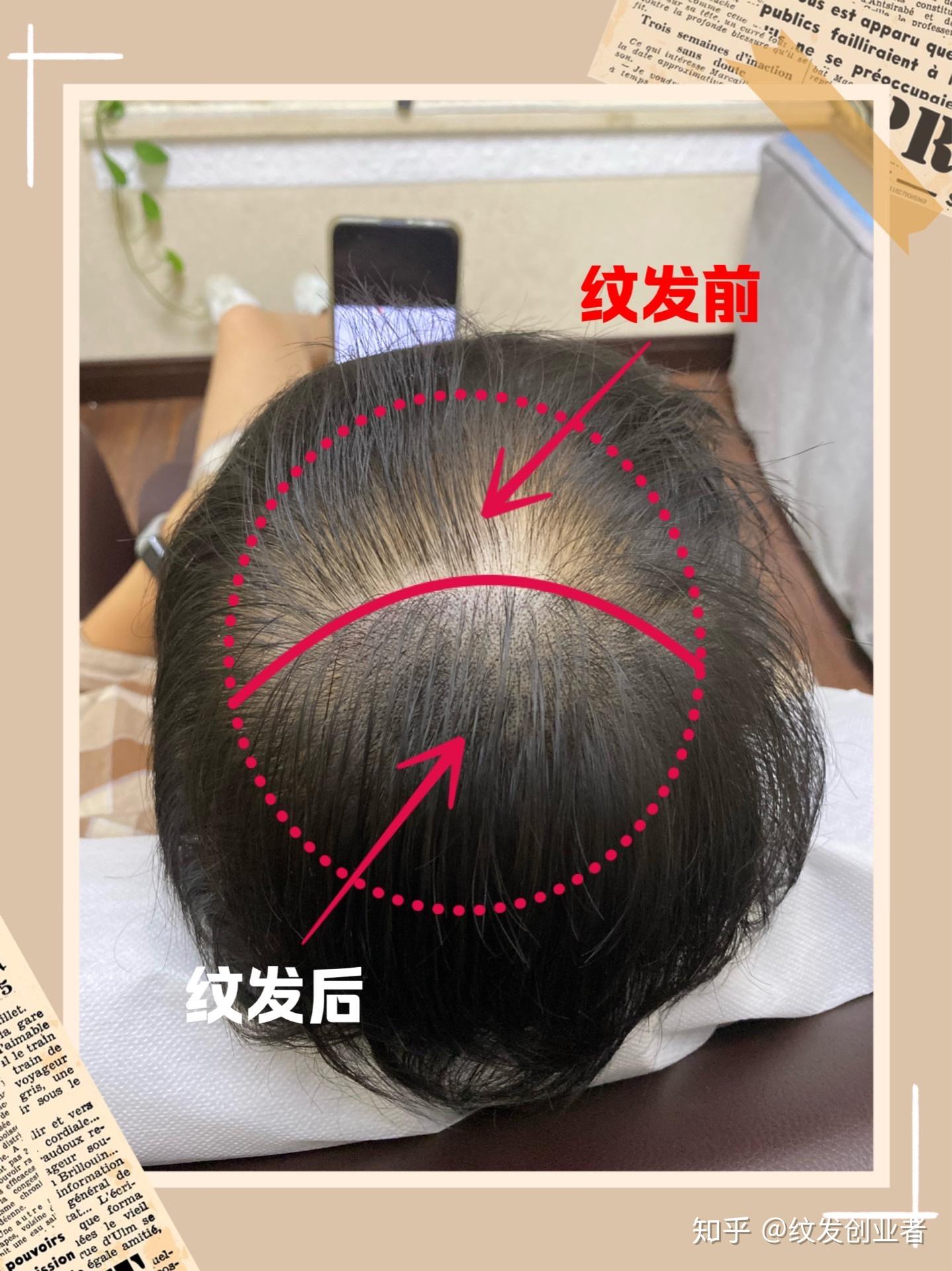对照假发发量标准,3d纹发可以达到掩饰脱发的目的吗?