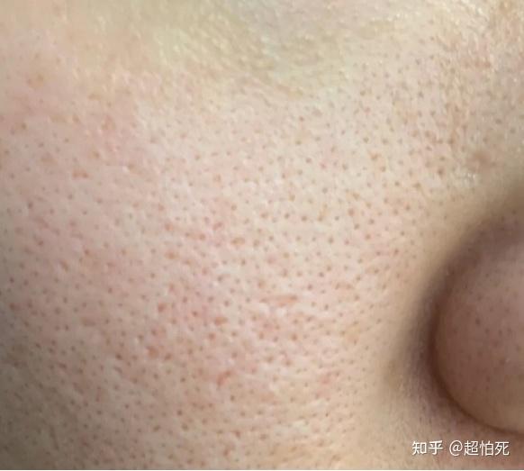 以前哥们的脸是真的糙啊,不仅毛孔大,还坑坑洼洼的.