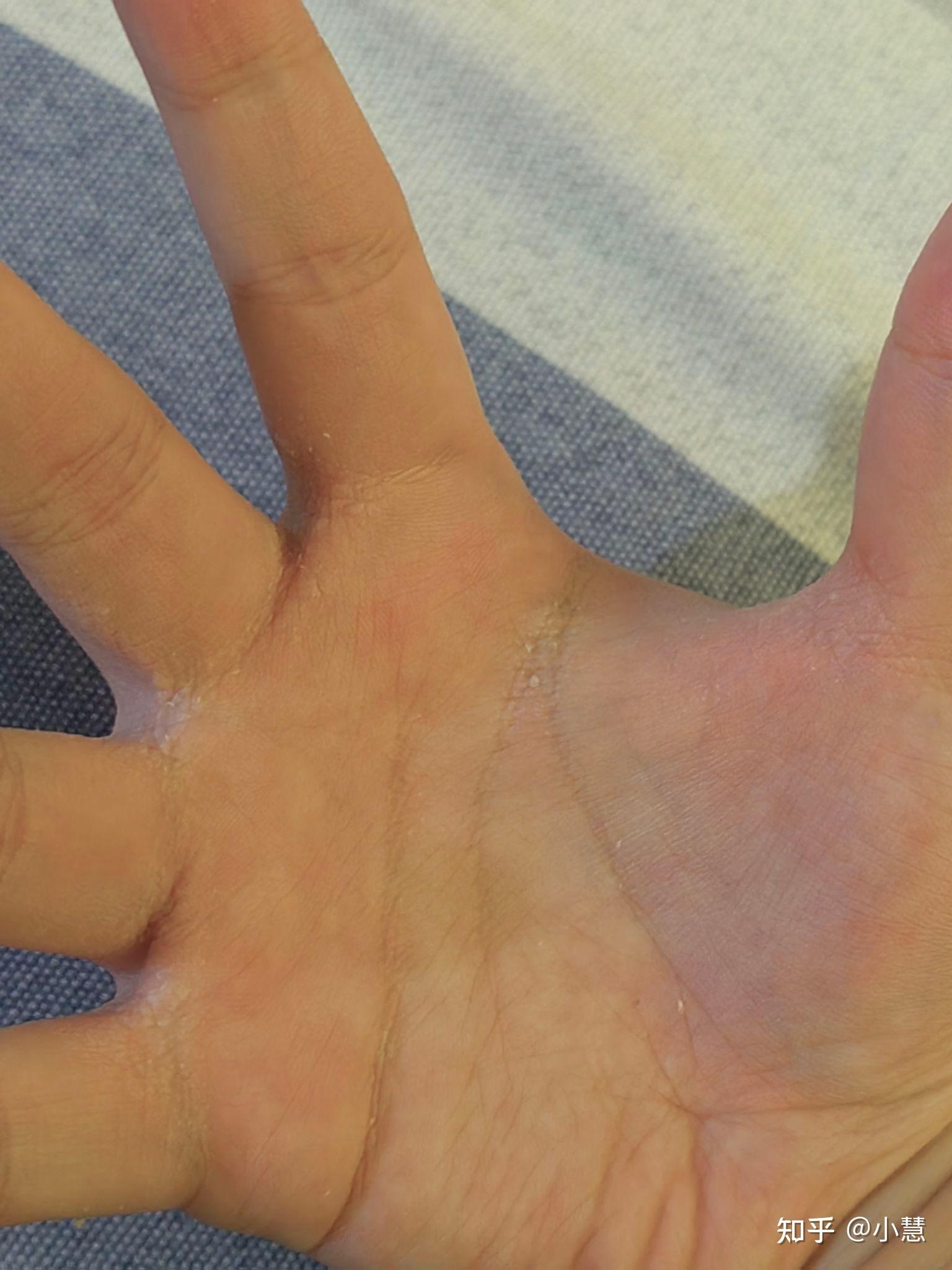 手指缝遇水起起皱脱皮?
