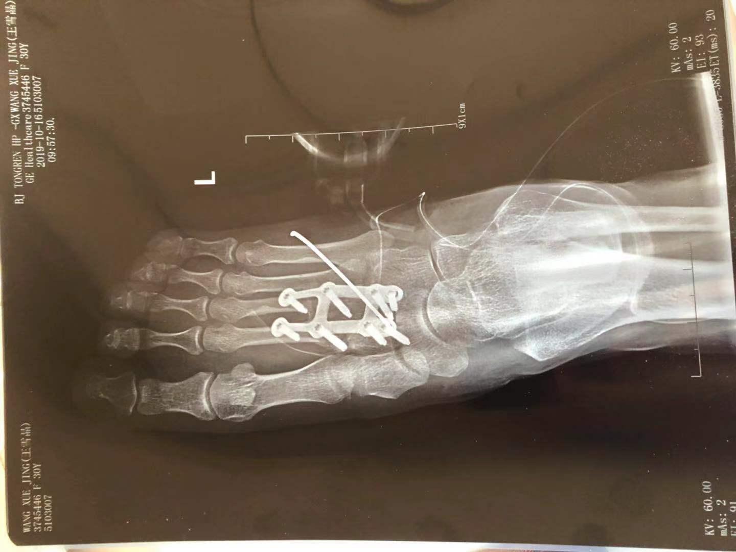 右手第五掌骨骨折，手术复位并植入钢钉固定，一月拆石膏，40天拔钢钉，现在44天，小拇指无法顺利弯曲。_百度知道
