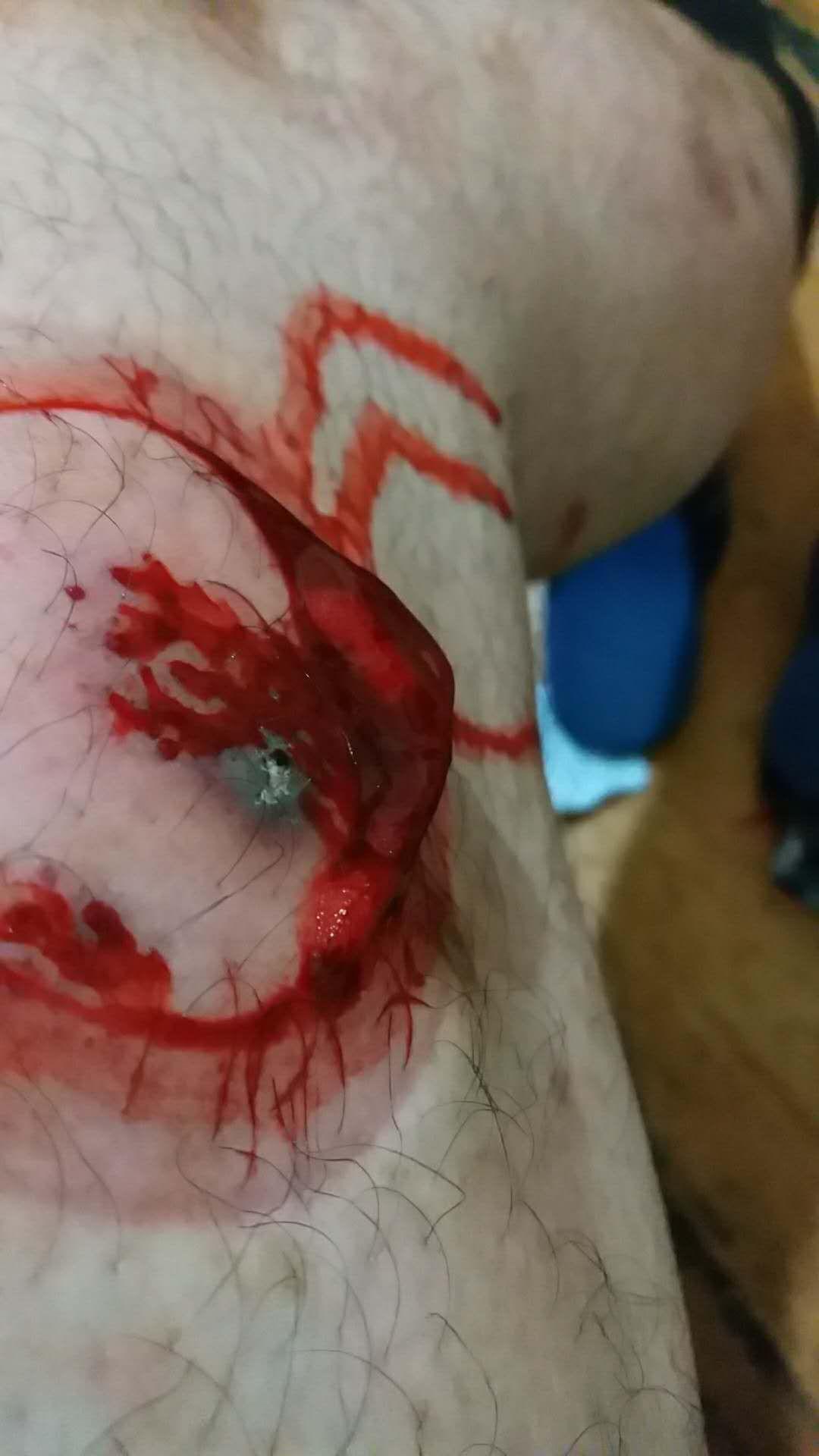 美容院 竹刺络排毒,好像跟拔罐差不多,拔出来的血都凝固的 说是淤血