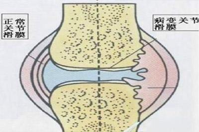 滑膜炎能被彻底根治吗？ 知乎
