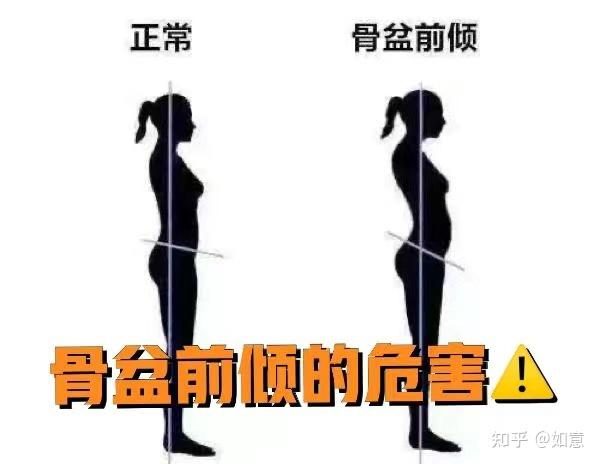 骨盆前倾的危害,这些你都知道吗---甄暖知识分享