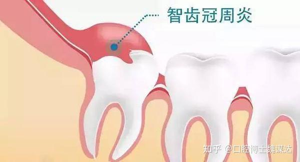 别再拿牙龈肿痛不当回事！小心拖到最后要“动刀”…… - 知乎