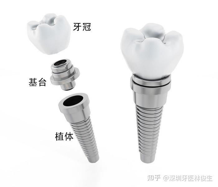 手术费 麻醉费,修复材料费,种植基台费,牙冠费