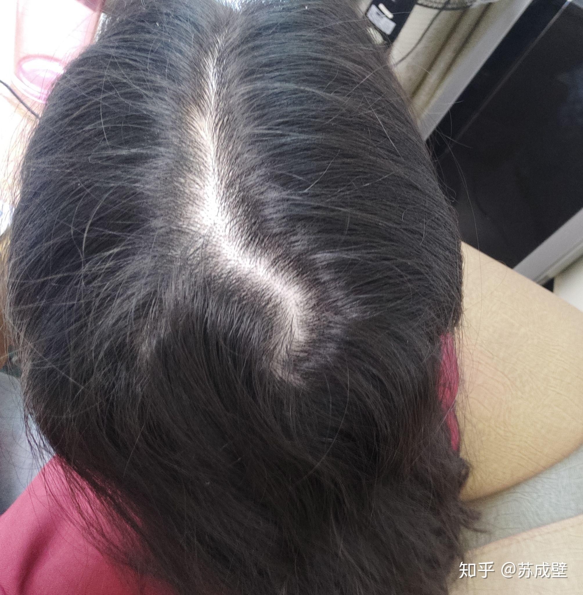 女生秃顶是怎样一种体验?