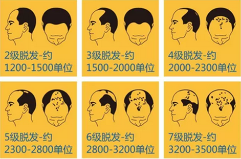 男士大面积植发费用(男士大面积植发费用高吗)
