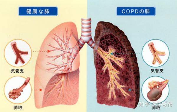 什么是肺气肿 原因 症状和治疗 知乎