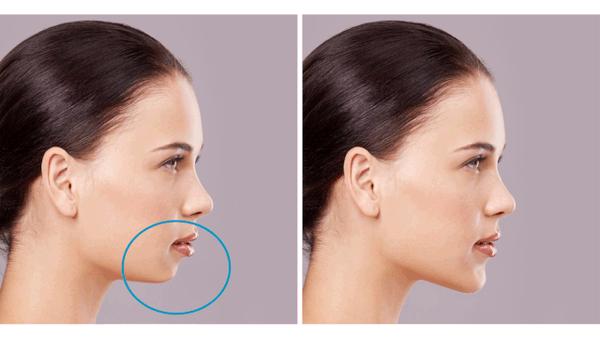 面部在社交中扮演美和情感的传递,鼻唇颏部的变化是美学评价的基础.