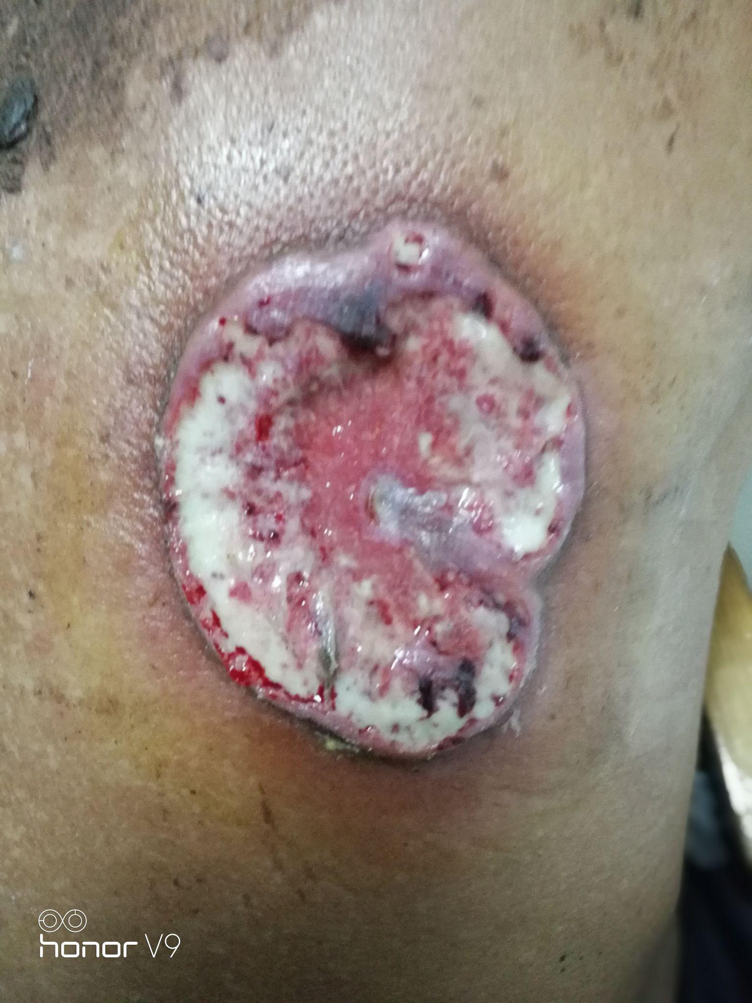 搭背疮如何医治有什么特效药