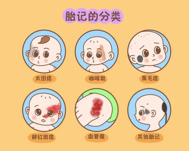 有些胎记可以消失,有些是病,得治! - 知乎