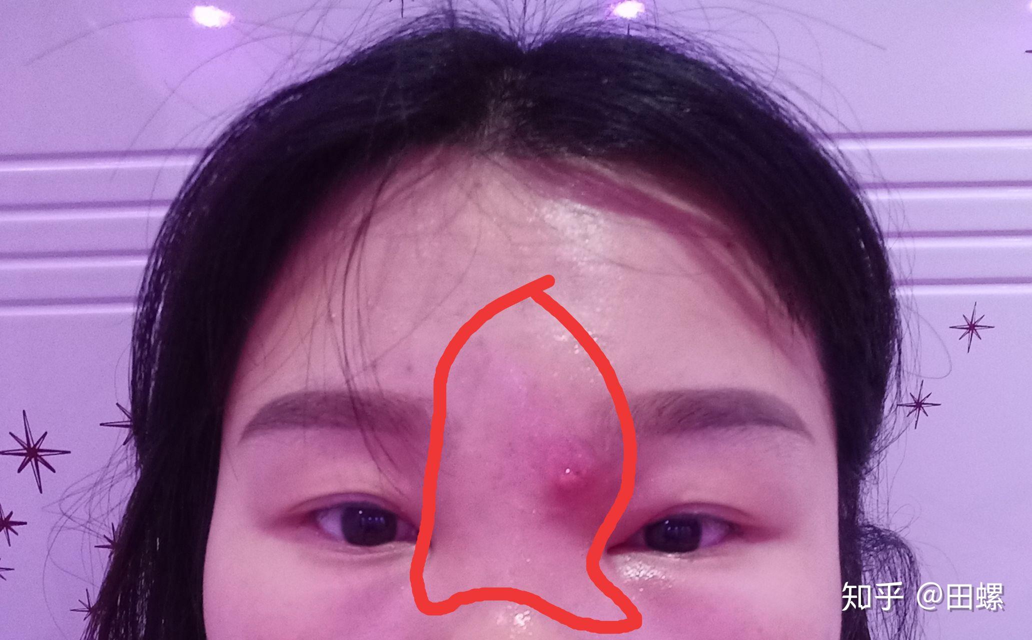 如何挤痘不留痘印呢? - 知乎