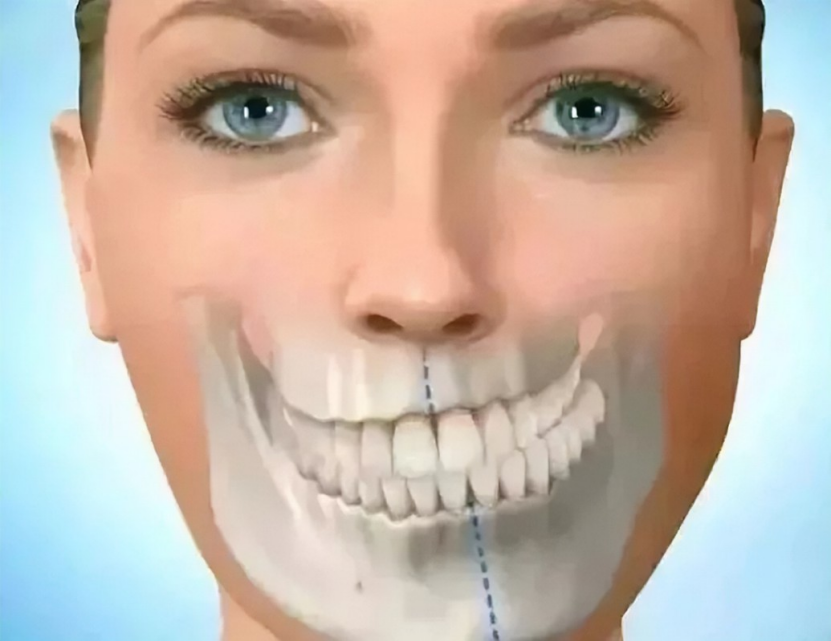 下颌骨不对称,右边脸下颌骨明显比左边大怎么办? - 知乎