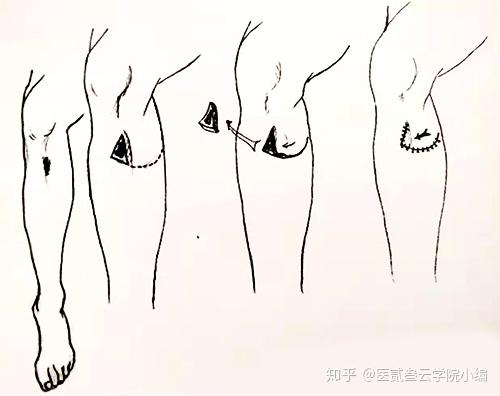 缝线足够紧张,又不能过紧.3.深层缝合以减少皮肤张力,要埋结.