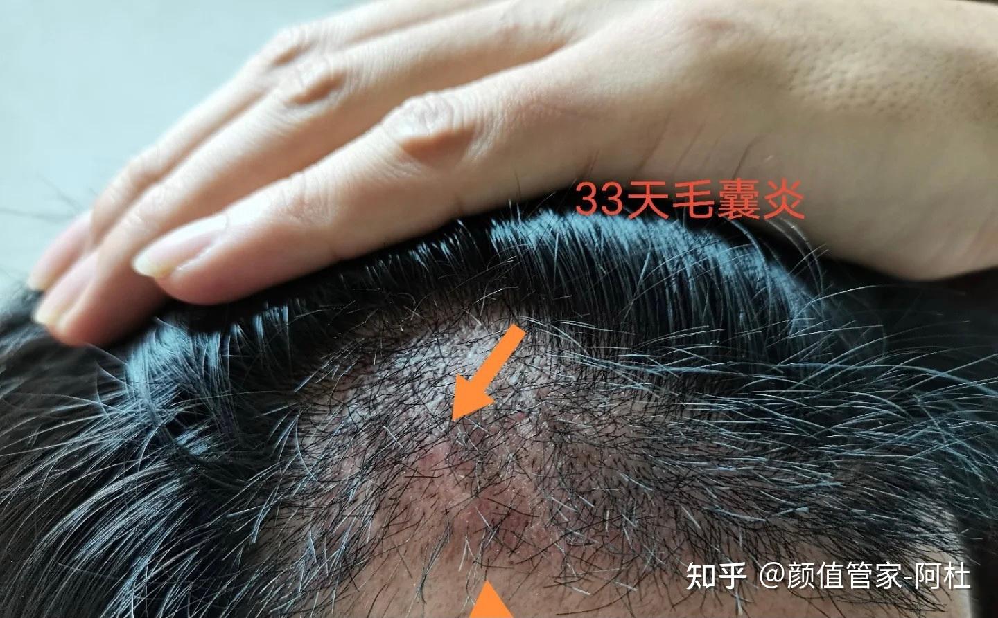 植发能植两次吗(植发能植两次吗图片)