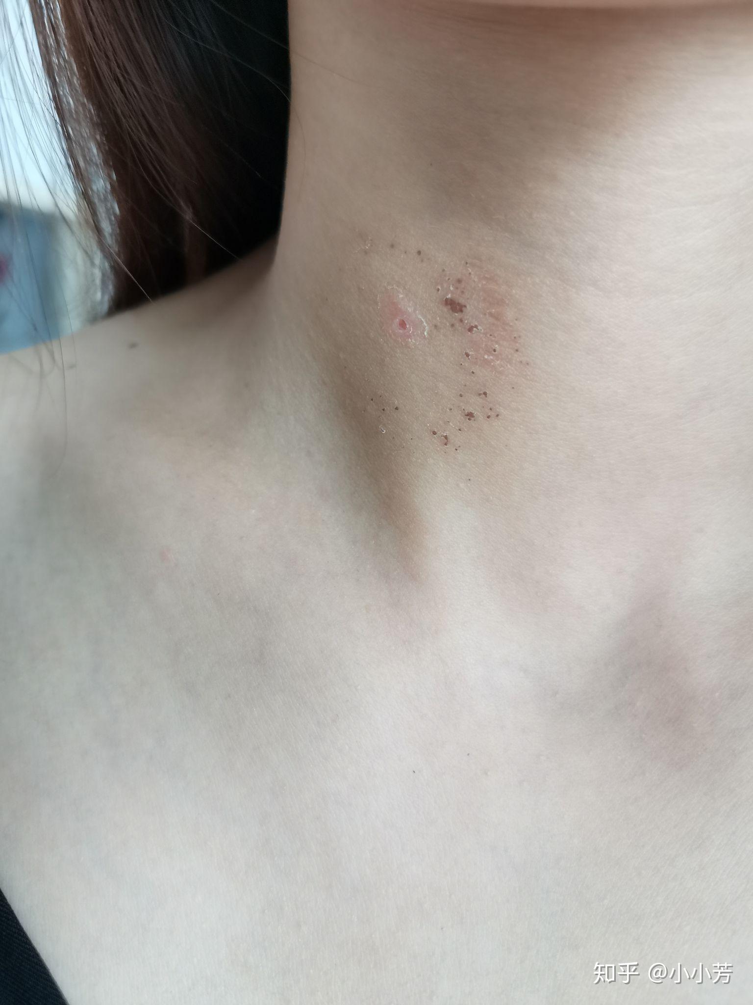 白醋祛除丝状疣