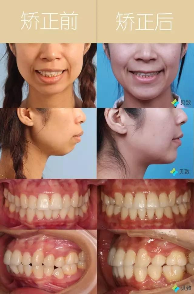 美学揭秘丨从凤姐的脸说起为什么嘴突的人普遍都不好看