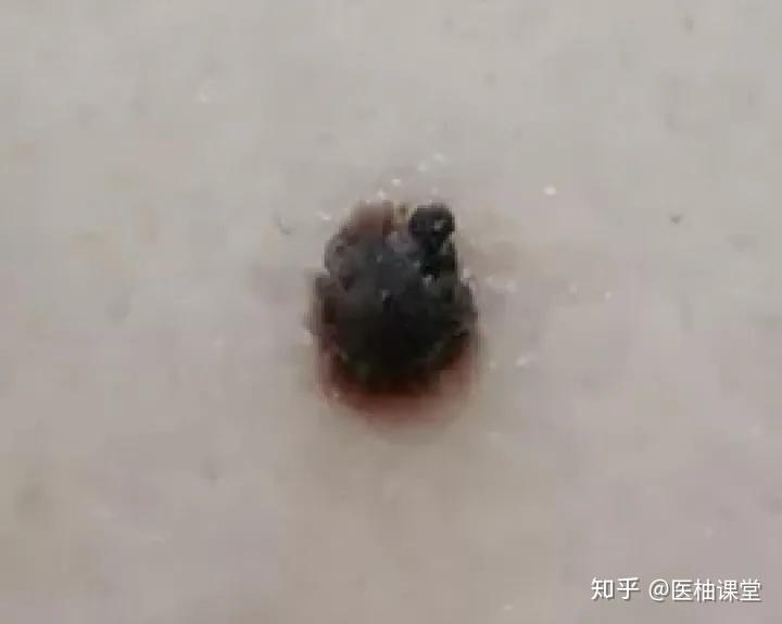 黑痣癌变， 从发病到去世不到两个月！这些痣千万要小心！ - 知乎