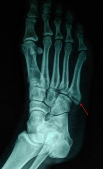 林书豪们的噩梦 场上的光鲜掩盖不了的伤痛 骨折就像家常便饭 知乎