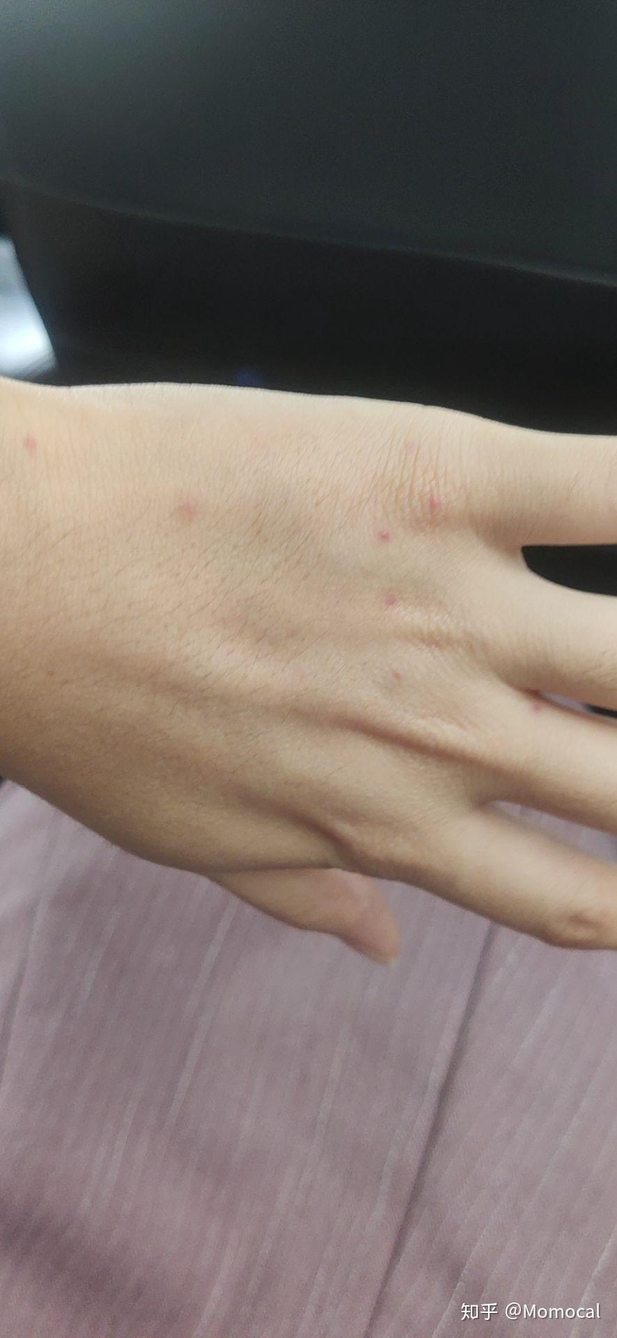 最近身上又长了几个红点像血点以前只有一个而且消不下去