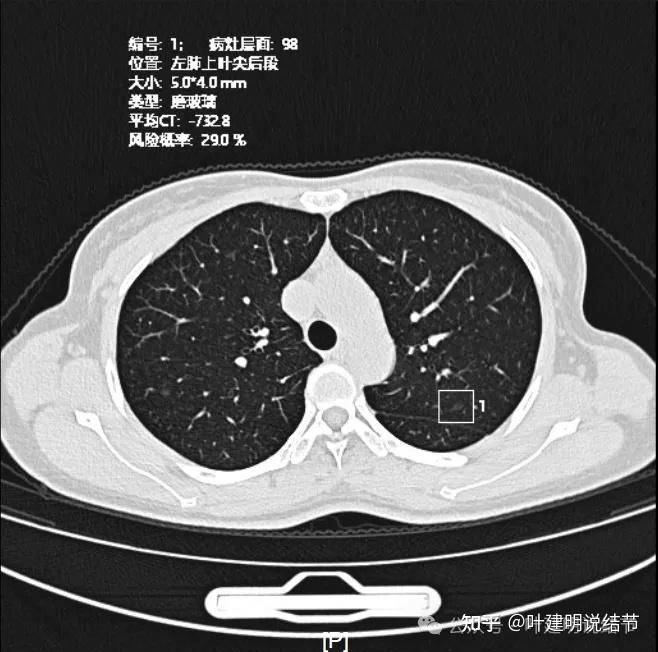 肺结节大小图片