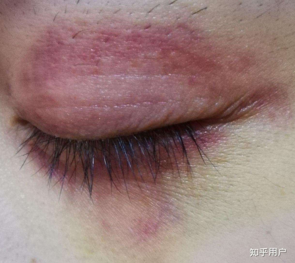 想知道眼部淤青怎么可以快速消除