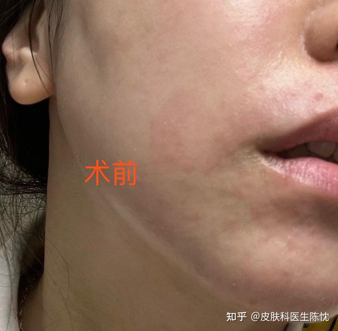 舒敏之星—敏感肌克星! - 知乎