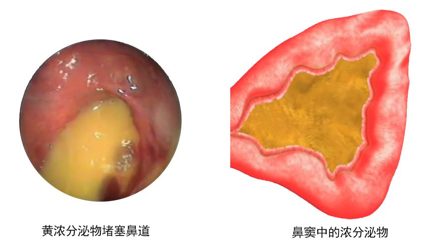 重树鼻子的健康与清爽你需要知道这些
