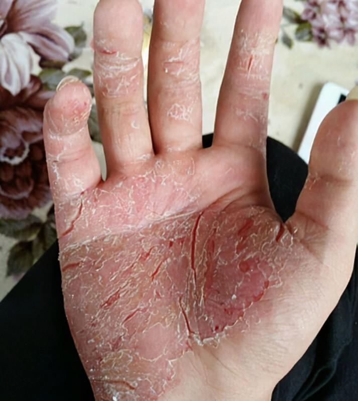 手掌皮肤变硬,开裂和脱皮,反复一年多了