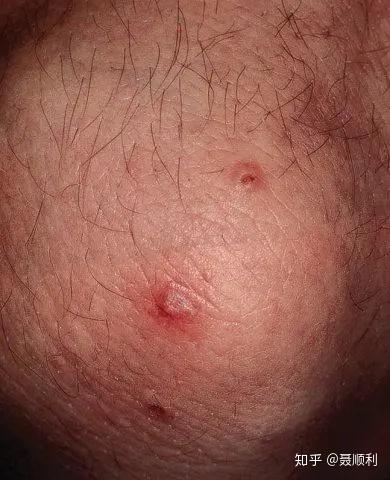 三,临床特征 1,疾病的自然进程 嗜酸粒细胞性肉芽肿性多血管炎(ega))