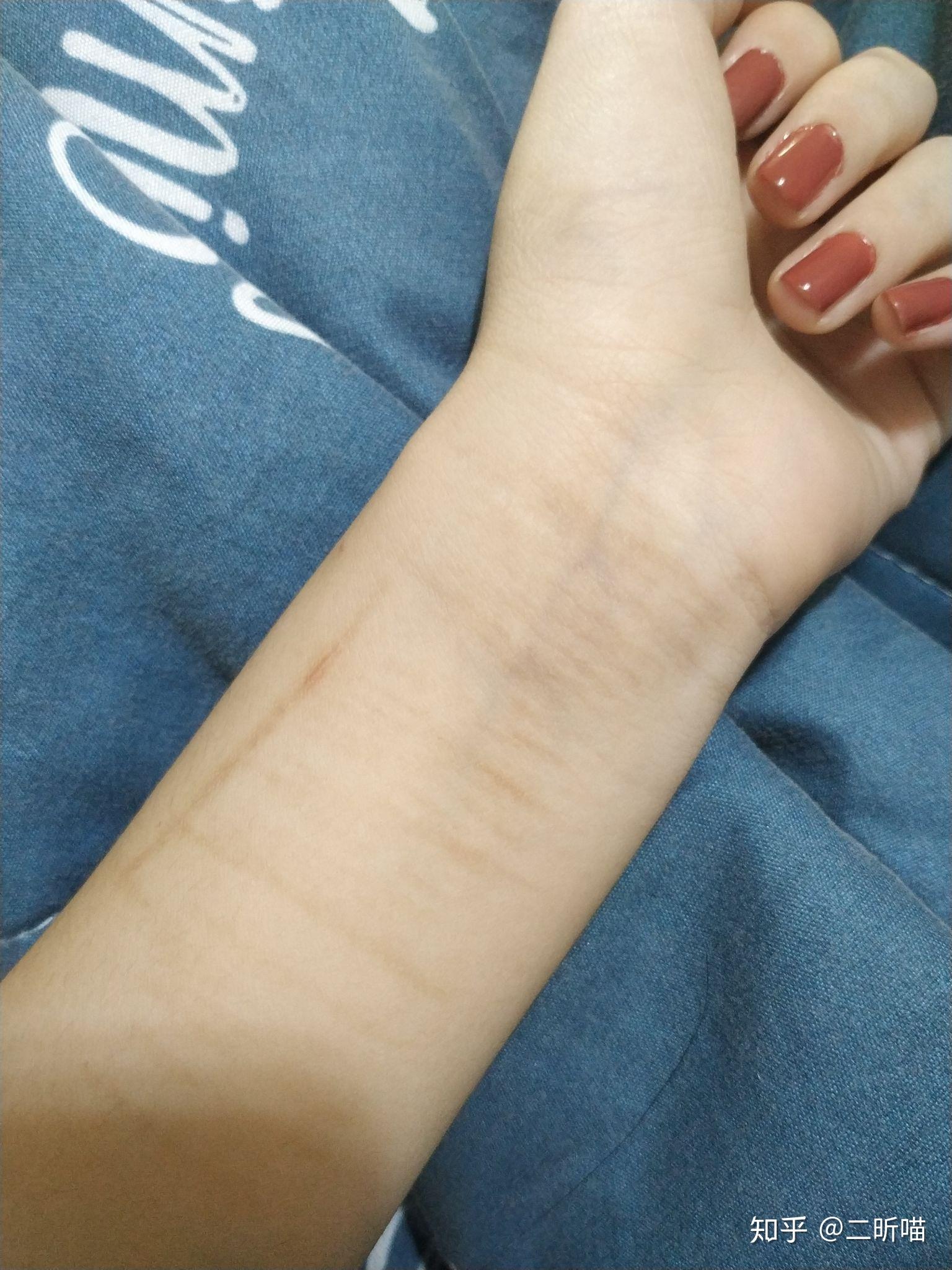 割腕的疤可以去掉吗