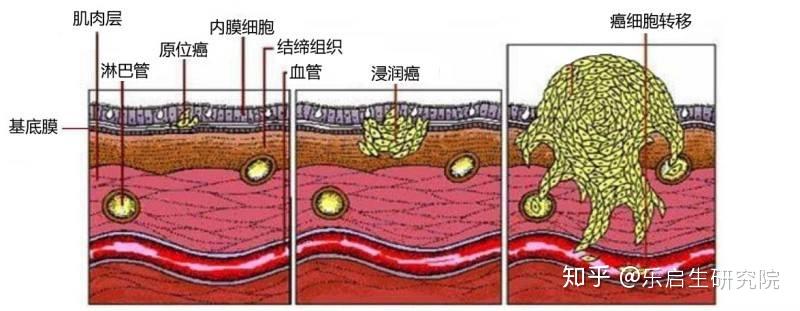 临床实践表明对付肿瘤综合治疗更高效有助于提高患者的