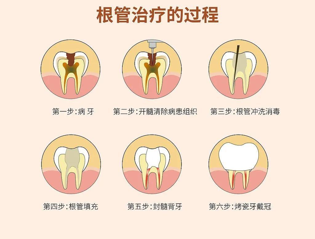 根管治疗有多痛