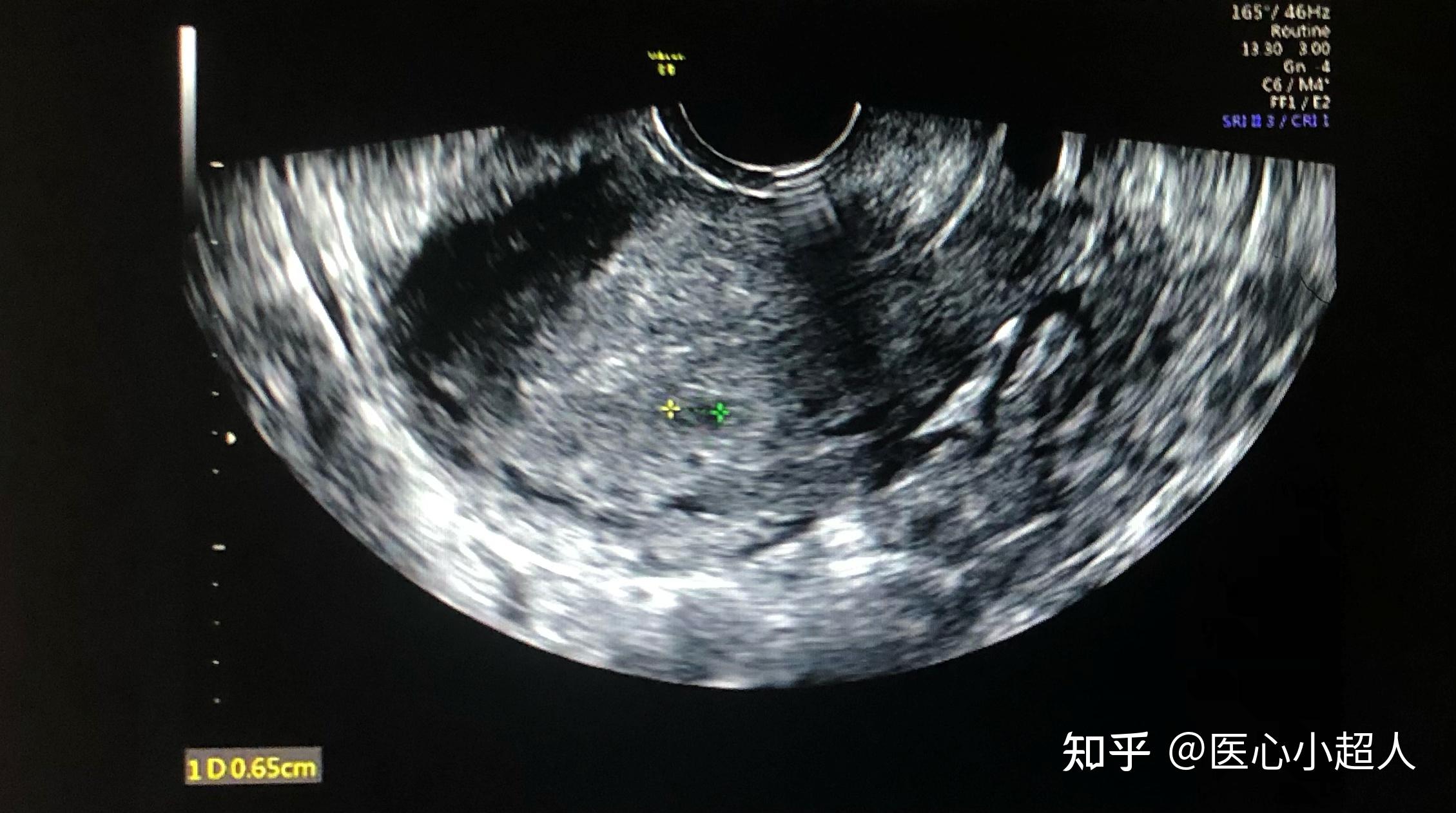 Anatomía del útero femenino: fotografía de stock © sciencepics ...