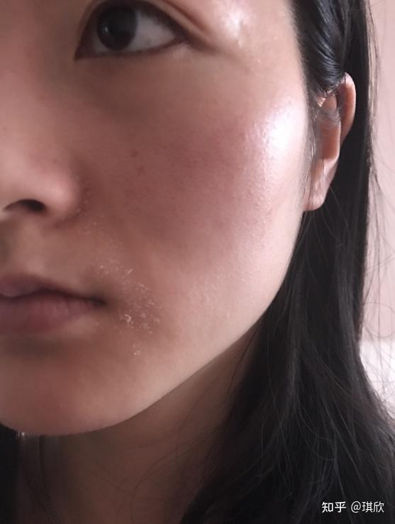 干敏皮加上脂溢性皮炎和皮肤屏障怎么办啊